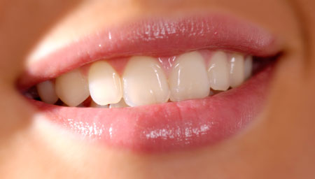 Politur jedes einzelnen Zahnes auch unter dem Zahnfleisch