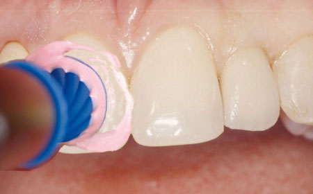 Gründliche Reinigung der Zähne mit verschiedenen Pasten