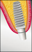 Nach der Abheilphase wird das Implantat zur Aufnahme des Zahn- ersatzes vorbereitet.